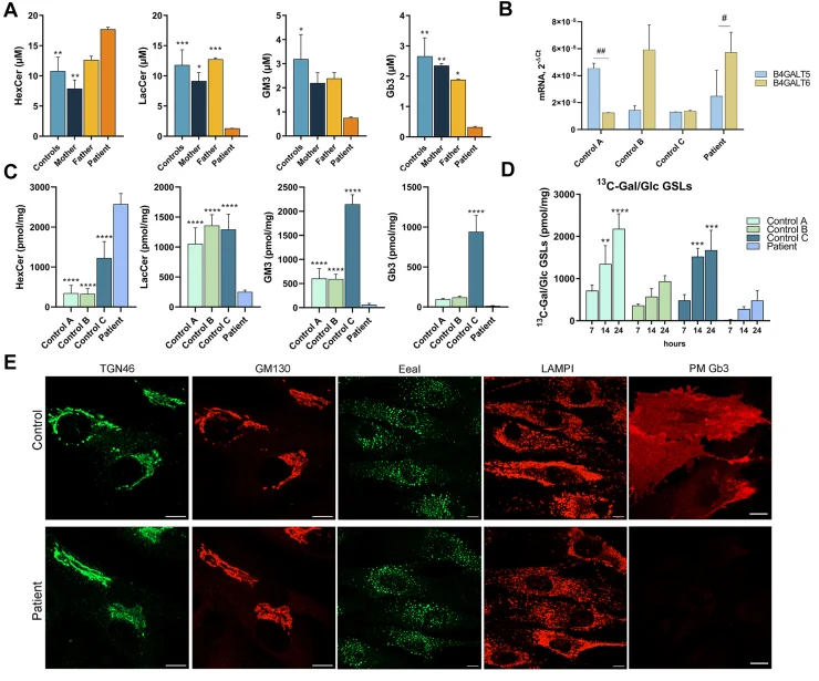 Analysis of patient plasma and fibroblasts in culture. A: Patient plasma was extracted and analyzed by LC-MS/MS together with plasma from her mother, father, and five age-matched healthy controls. In this panel, glycosphingolipids are reported as the sum of individual species with fatty acyl chains